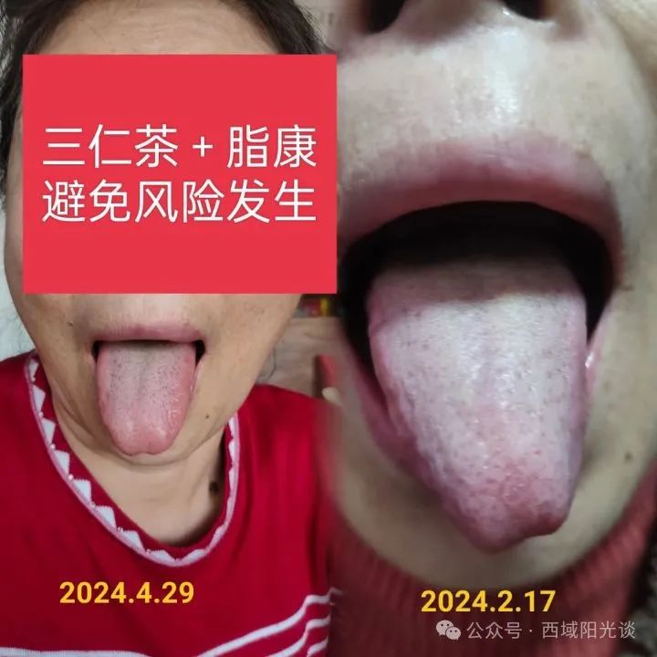 胆管癌术后营养吃什么最好_术后胆管癌的治愈率是多少_胆管癌术后的营养餐